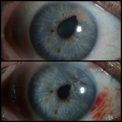 Tumor dužice oka pre i posle operacije