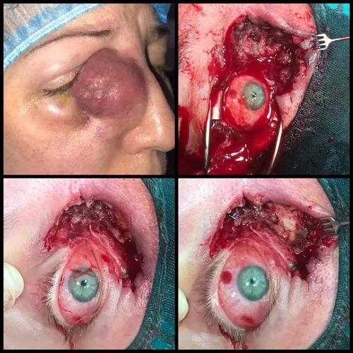 запуштени карцином сузне кесе тумор орбите ока